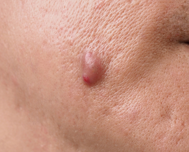 Trị Mụn Viêm Mụn Mủ Tại Sen Beauty